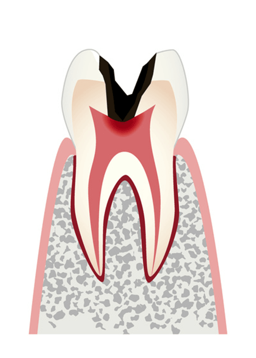 歯髄（神経）に達したむし歯